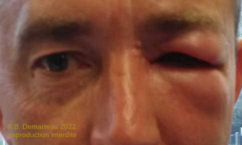 Photo en gros plan des yeux d'une personne, l’œil gauche est fortement enflé suite à une piqûre.
